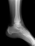 Ankle X Ray