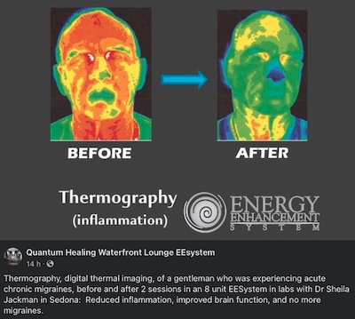 ee-thermography-migraine image
